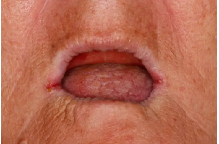 Figure 1 – Clinical aspect of angular  cheilitis characterized by maceration,  erythe-ma, and crust formation of corners of mouth.
