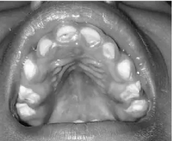 Figure 2. Oral findings in a child with Congenital Zika Syndrome  (subject 5): presence of dental caries, narrow and deep palate and 