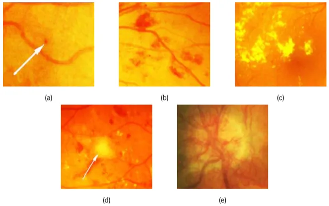 Figura 2.3: Diferentes tipos de lesões causados por retinopatia diabética: (a) microaneurisma; (b) hemorragias;