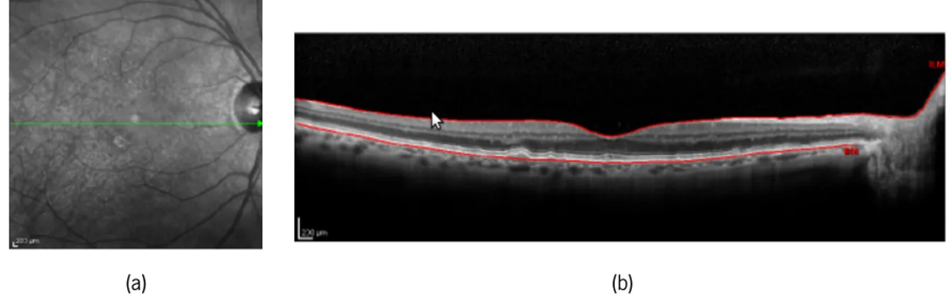 Figura 2.6: Excerto de uma retinografia (a) e uma secção obtida por OCT (b) (imagens retiradas de [6])