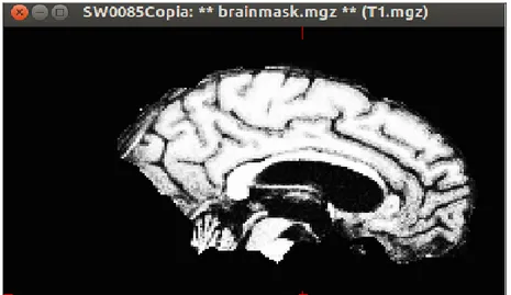 Figura 2.6 Vista sagital com parte do cérebro retirado 3.  Verificação as superfícies da substância branca e pial  