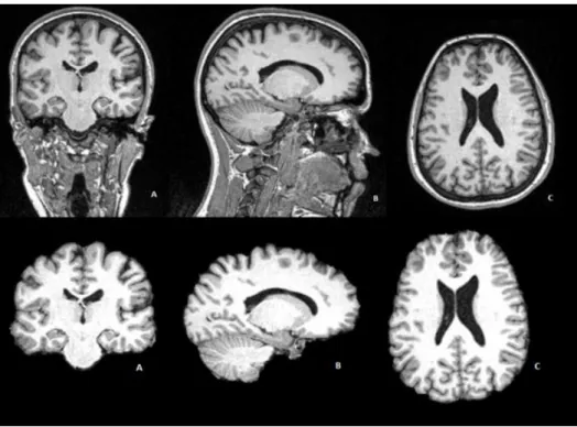 Figura 3.11. Comparação entre a imagem original e a imagem após o processamento com o BET nos  cortes coronal (A), sagital (B) e transversal (C) 