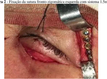 Figura 2 - Fixação da sutura fronto-zigomática esquerda com sistema 1.5mm