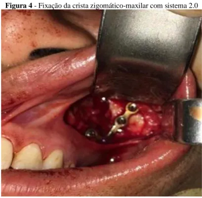 Figura 4 - Fixação da crista zigomático-maxilar com sistema 2.0