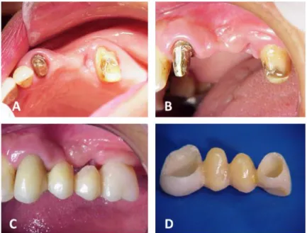 Figure 1 – (A) Initial clinical case; (B) Initial condition of gingival tissue; (C) Initial provisional crowns, evidencing the  need  of  relining  the  pontics  at  the  cervical  region  for  gingival  modeling;  (D)  Addition  of  acrylic  resin  at  th
