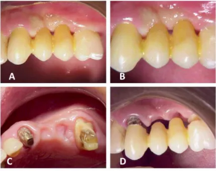 Figure 3 – (A) Final condition of gingival tissue after conditioning by gradual pressure (buccal view); (B) Final condition  of gingival tissue after conditioning by gradual pressure, evidencing the formation of interdental papillae; (C) Fitting and  adjus