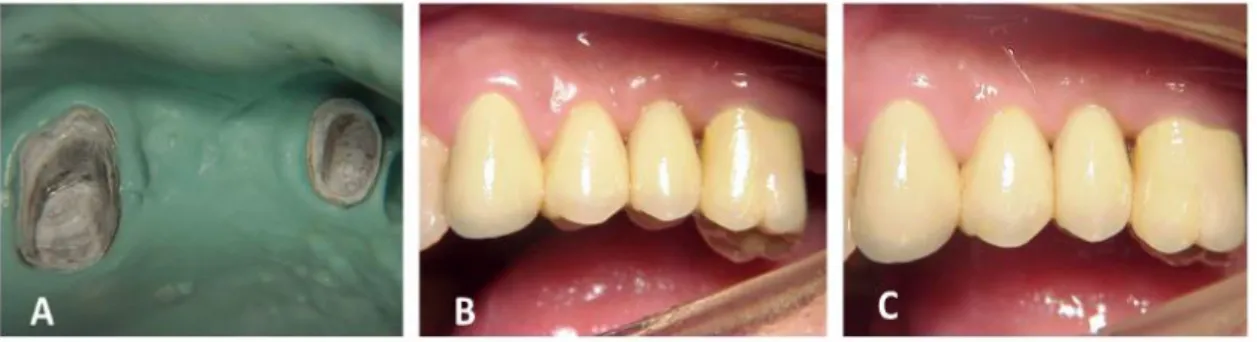 Figure 4 – (A) Removal of metallic framework from an alginate impression; (B) Definitive cementation of fixed partial  denture; (C) Final case