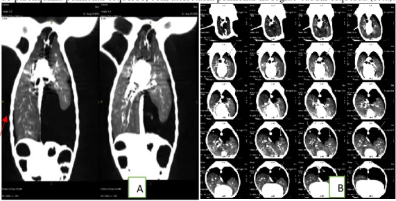 FIGURA 3 – Avaliação tomográfica da região torácica vista ventral A e B, demonstrando grande quan-tidade de ar livre  extravasado do parênquima pulmonar esquerdo, com atelectasia pulmonar na região caudal esquerda (seta)
