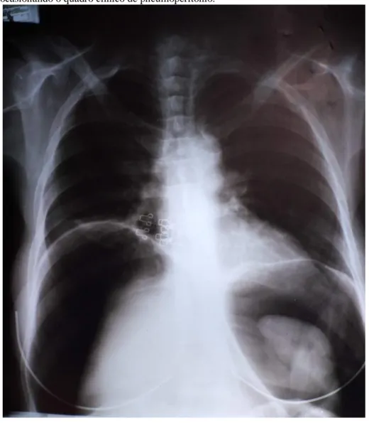 Figura 1: Raio-X evidencia o deslocamento do fígado, consequência do extravasamento de gases intestinais, devido a  ruptura do ceco, ocasionando o quadro clínico de pneumoperitônio