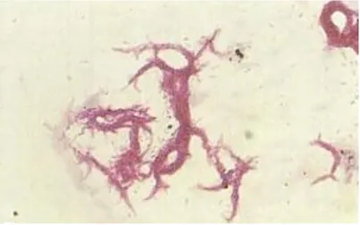 Figura 1: Bacilos de Mycobacterium tuberculosis agrupados em corda. 