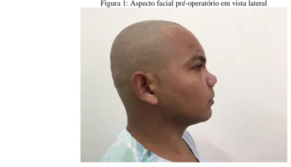 Figura 1: Aspecto facial pré-operatório em vista lateral 