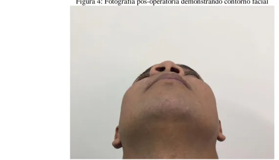 Figura 4: Fotografia pós-operatória demonstrando contorno facial 