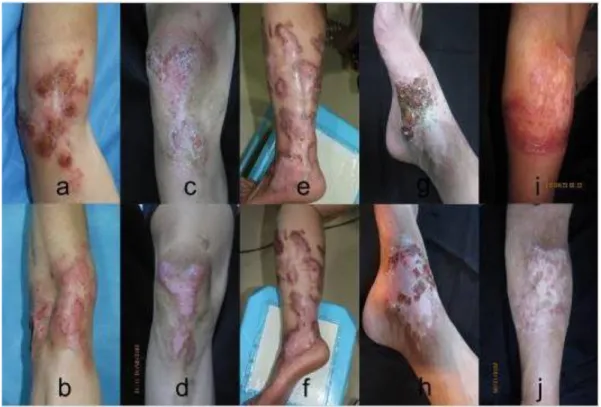 Figure 3: Clinical aspect of chromoblastomycosis lesions in patients before and after treatment (HU e colab., 2019)
