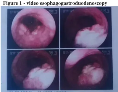 Figure 1 - video esophagogastroduodenoscopy 
