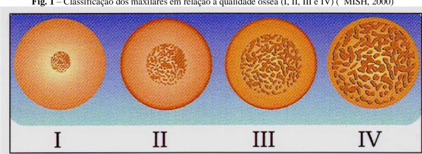 Fig. 1 – Classificação dos maxilares em relação à qualidade óssea (I, II, III e IV) (  MISH, 2000) 