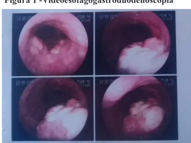 Figura 1 -Videoesofagogastroduodenoscopia