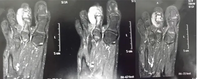 Figure 1: NMR of left foot showing a lesion in 2nd toe. It is remarkable the  involvement of soft parts, suggesting biological aggressiveness, being characteristic 