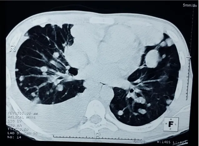 Figure 3: Computed tomography of the chest showed nodular formations of  varying sizes in both lungs, and on the right, moderate pleural effusion