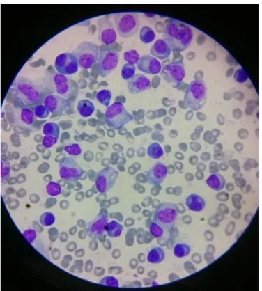 Figure 1 - Myelogram  evidencing Plasmacytosis  of a case study of MM, Montes Claros, MG, 2018