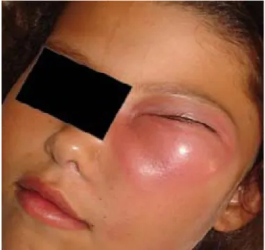 Figura 1 Fotografia de face. Observa-se edema periorbitário,  sinais de celulite periorbitária e exoftalmia do olho esquerdo