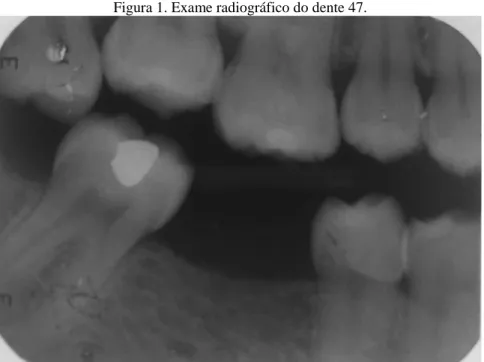 Figura 1. Exame radiográfico do dente 47. 