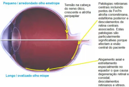 Figura 1-1  Representação esquemática das diferenças de  dimensões anatómicas entre o  olho míope e o olho emetrope e potenciais complicações patológicas associadas à miopia