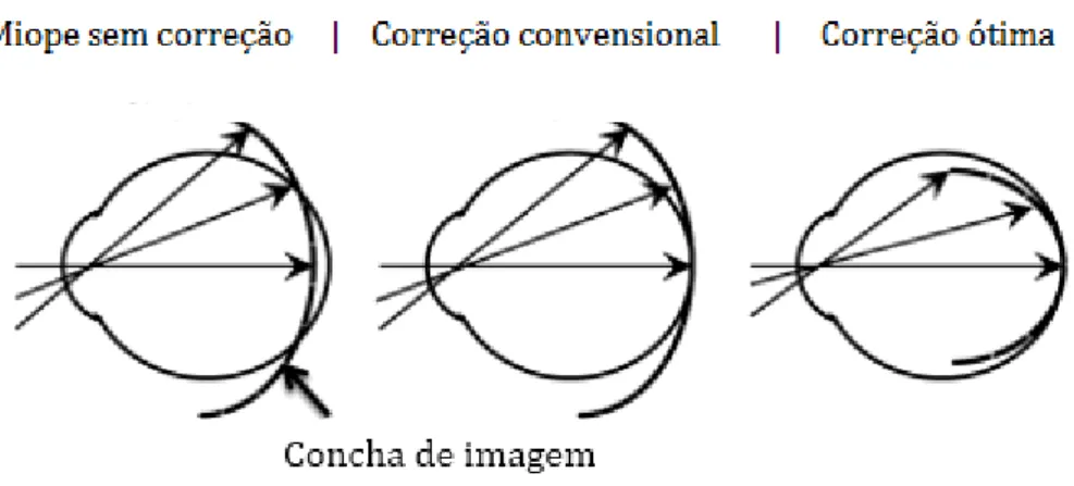 Figura  1-7  Esquema  das  metas  indicadas  para  a  correção  ótima  da  miopia  com  vista  à  retenção da progressão da miopia
