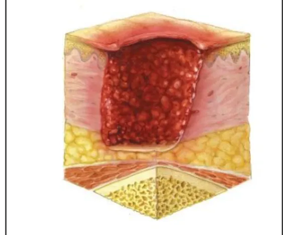 Figura 2.6 - Úlcera de Pressão de Categoria III