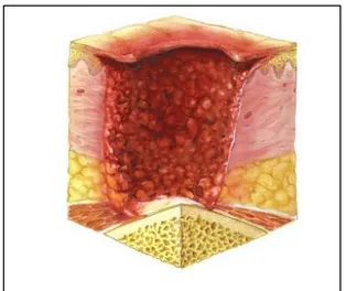 Figura 2.7 - Úlcera de Pressão de Categoria IV