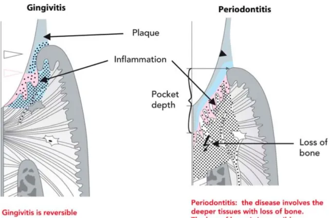 Figure 1. Representation of a chronic inflammatory infiltrate below the gingival margin  (Gingivitis) and a  chronic inflammatory condition affecting deeper periodontal tissues (connective tissue attachment and bone), a 