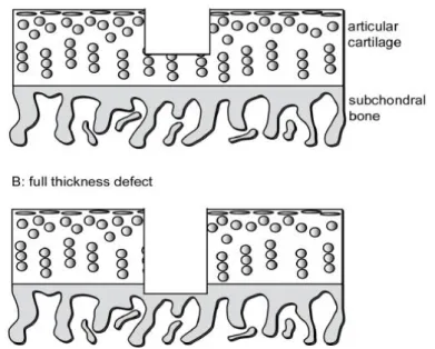 Figure I-2:  Comparison between partial thickness defects and full thickness defects [28]