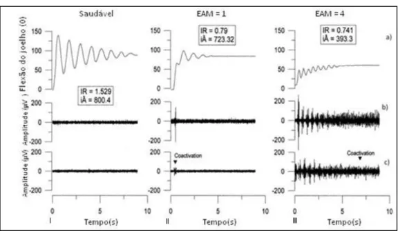 Figura 2  Exemplo dos resultados obtidos pelo método do pêndulo. Em I), indivíduo saudável, em II), individuo avaliado com  grau 1, em III), indivíduo avaliado com grau 4