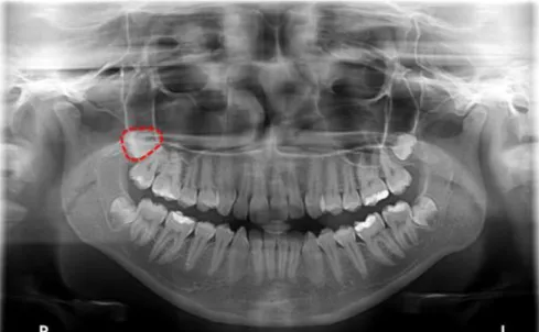 Figure  1:  Preoperative  panoramic  radiography.  Highlighted  in  red:  unerupted  tooth  18  in  distoangular  position  with  incomplete root formation