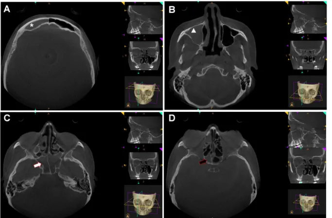 Figure  2:  Computed  tomography  of  the  face,  transversal  section:  asterisk  -  right  frontal  sinus  (RFS);  white  triangle  -  right maxillary sinus (RMS); white arrow - right sphenoidal sinus (RSS); black arrow - right ethmoidal sinus (RES)