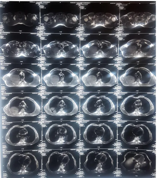 FIGURA 2: TC de tórax evidenciando massa em região de ápice pulmonar direito. 