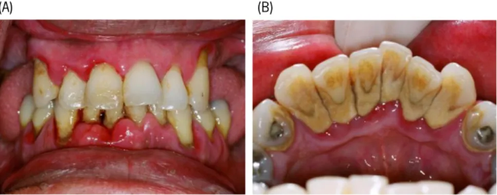 Figure 1.2 – Periodontal disease. (A) A case of advanced periodontitis, evidencing very swollen gums,  loose teeth, staining and heavy plaque and calculus deposits on all the teeth