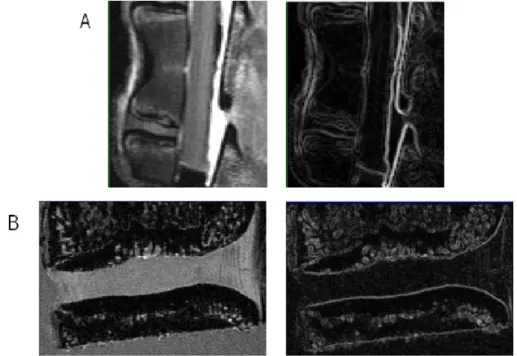 Figure 4.5 – The gradient magnitude filter applied to the (A) MR and (B) micro-MR images