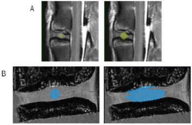 Figure 4.8 – The segmentation of the IVD with the geodesic active contour applied to the (A) MR and (B) micro-MR  images