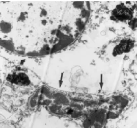Figure 8: Aluminium inflammatory response of Al-based GICs resulting in an irregular  density at the specific positions (arrowheads) [85]