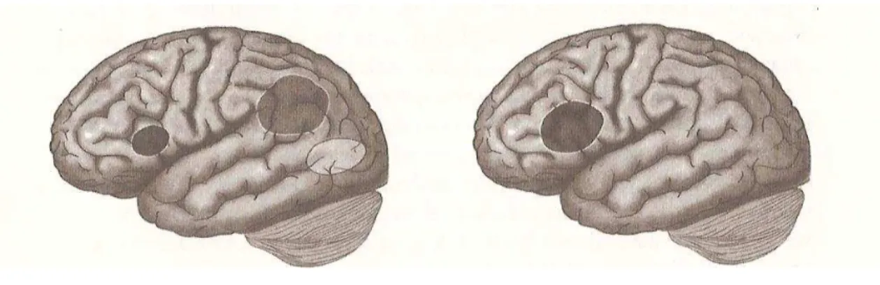 Figura 1. A marca neurológica da dislexia: subactivação dos sistemas neurais da área  posterior do cérebro e sobreactivação das áreas anteriores (Shaywitz, 2003)
