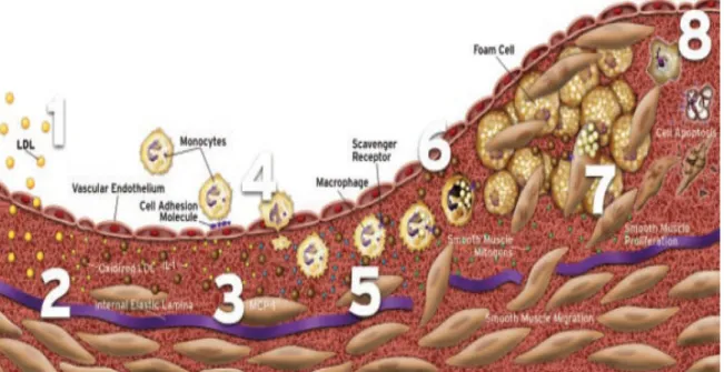 Fig.  5:  Desenvolvimento  em  8  estágios  de  uma  placa  de  ateroma:  1)  e  2)  migração  do  LDL  para  o  subendotélio e sua oxidação pelos macrófagos e células musculares lisas; 3) e 4) libertação de factores  de crescimento e citoquinas atraindo  