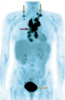 Figure  6.  Positron-emission  tomography  imaging  with  18 fluorodeoxyglucose  of  a  patient  with  lymphoma