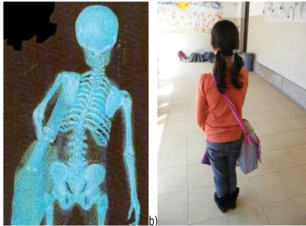 Fig. nº29: Transporte de saco escolar a tiracolo: a) raio-X posterior de uma criança  que carrega muito peso no saco escolar; b) exemplo real 