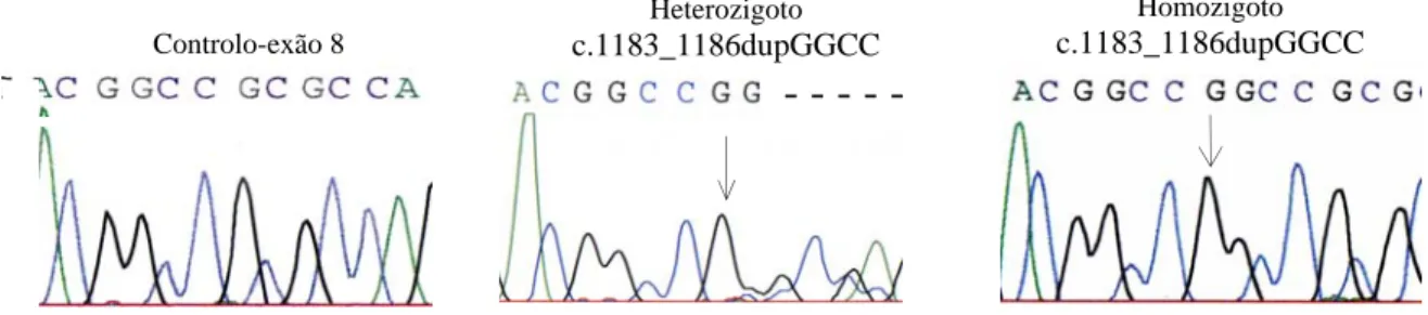 Figura 4.4 Mutação c.1183_1186dupGGCC (p.R396fsX76). Representação parcial da sequenciação do  exão 8 (fragmento 8B)