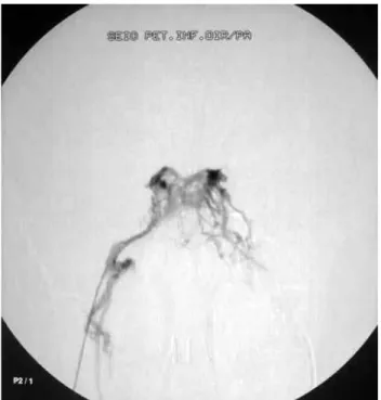 Figura 2. Cateterização do SPI direito com venograia retrógrada –  Imagem em projeção posteroanterior