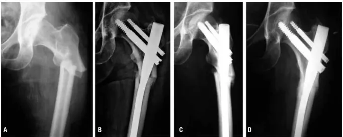 Figura 2. Evolução radiográica do caso 3 desde a fratura inicial até a formação de calo ósseo após ixação cirúrgica