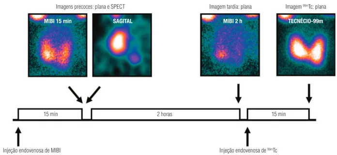 figura 1.  Protocolo completo de cintilografia das paratiroides: imagens planas precoce (15 minutos) e tardia (2 horas) com MIBI, imagem plana com  99m Tc  e imagem SPECT com MIBI.