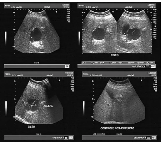 Figura 2. US abdominal: formação cística de contornos bem definidos, com finas septações, medindo cerca de 5,6 x 4,2 cm, no lobo  esquerdo do fígado