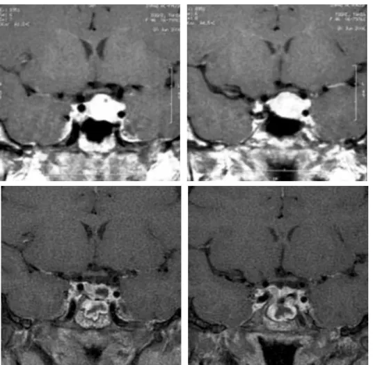 Figura 1. Ressonância de magnética (RM) de hipófise: imagens superiores; cortes coronais em T1 com contraste