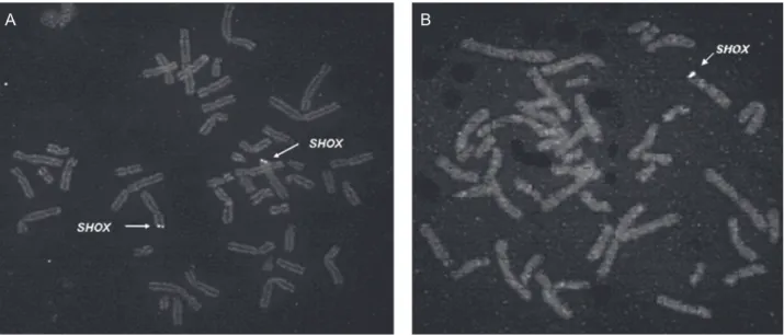 Figura 4.  Análise de citogenética por FISH utilizando sonda específica para o gene SHOX
